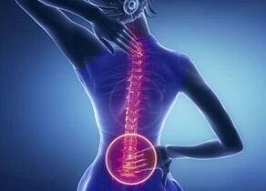 Manifestacións da osteocondrose lumbar